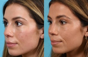 Female patient before and after rhinoplasty