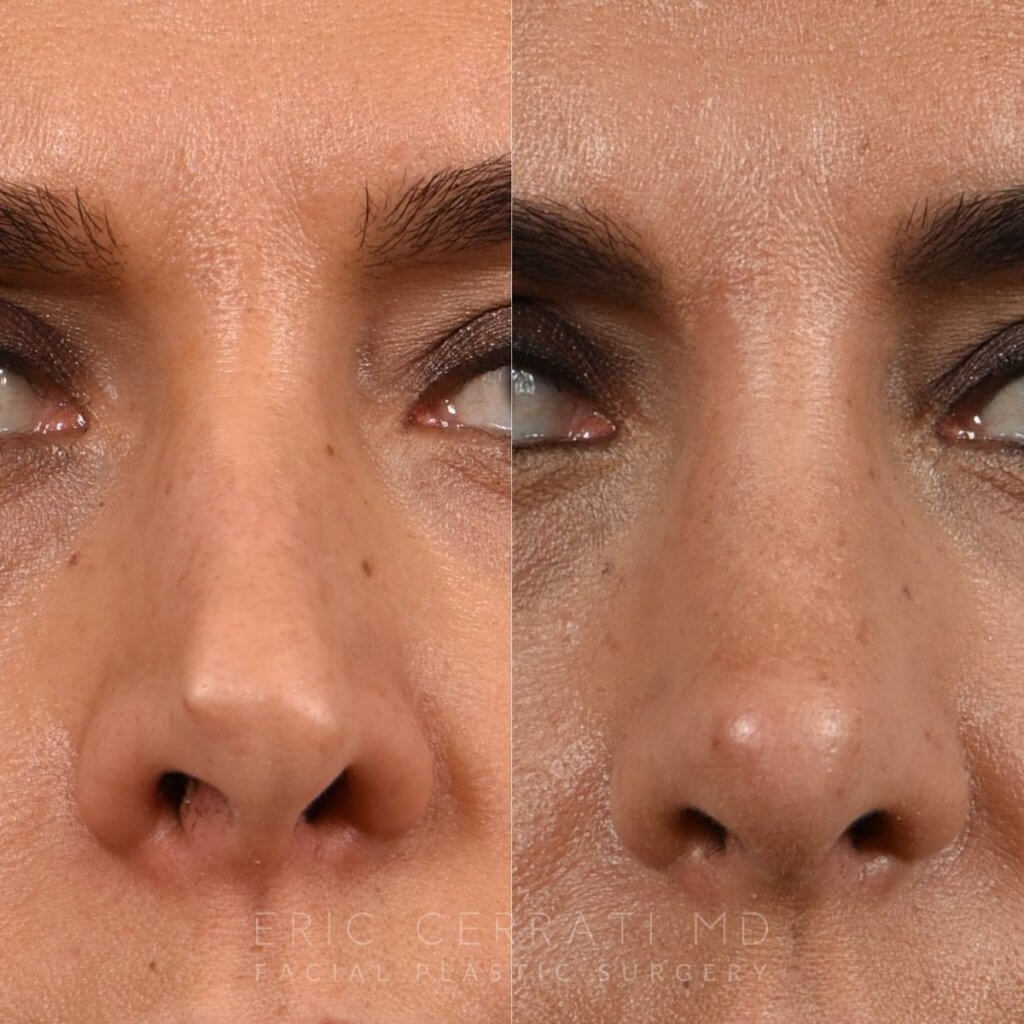 Female Patient Before and After Rhinoplasty