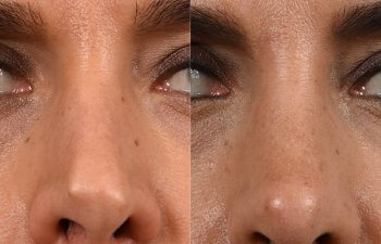 Female Patient Before and After Rhinoplasty