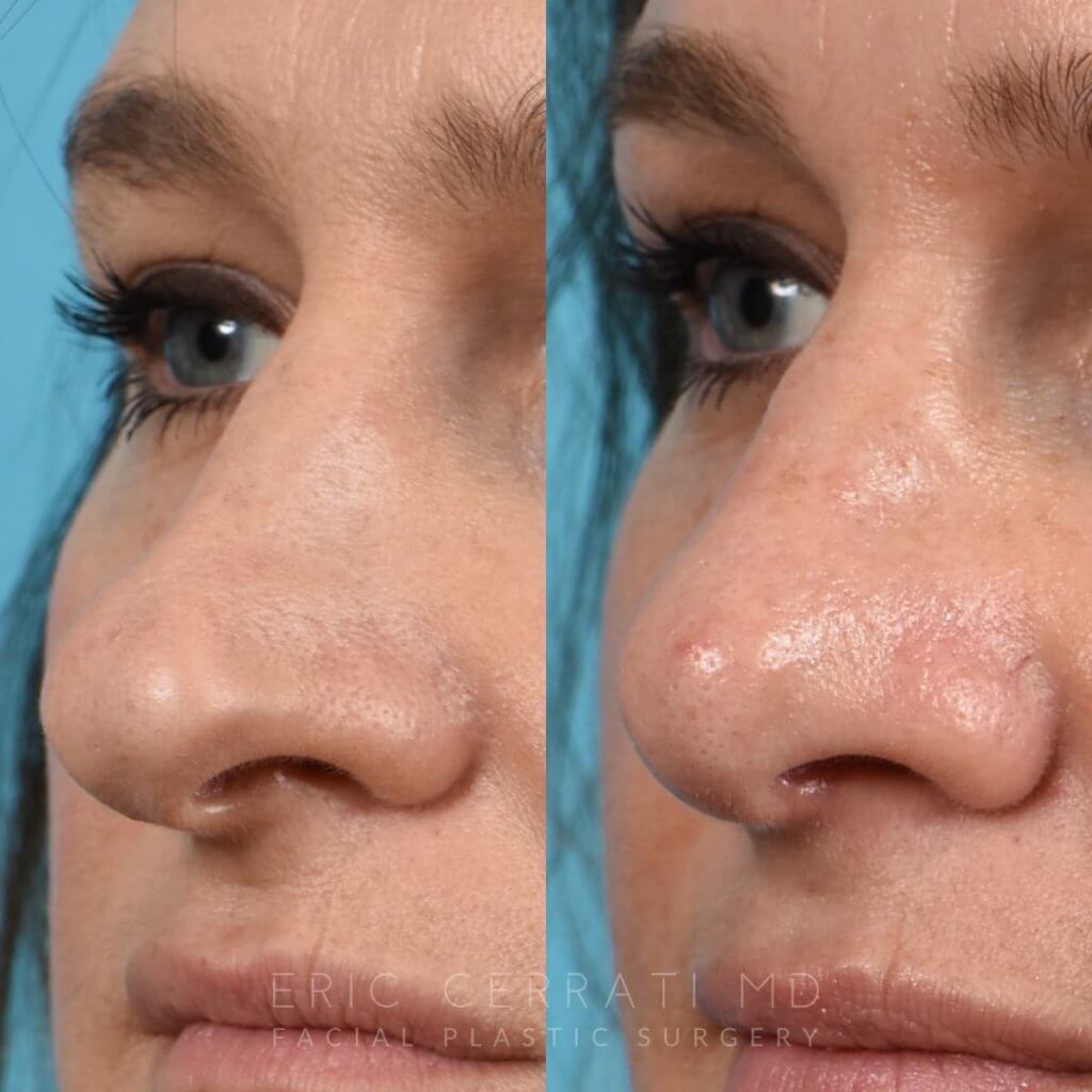 Female patient before and after rhinoplasty - left side