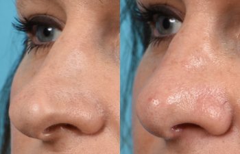 Female patient before and after rhinoplasty - left side