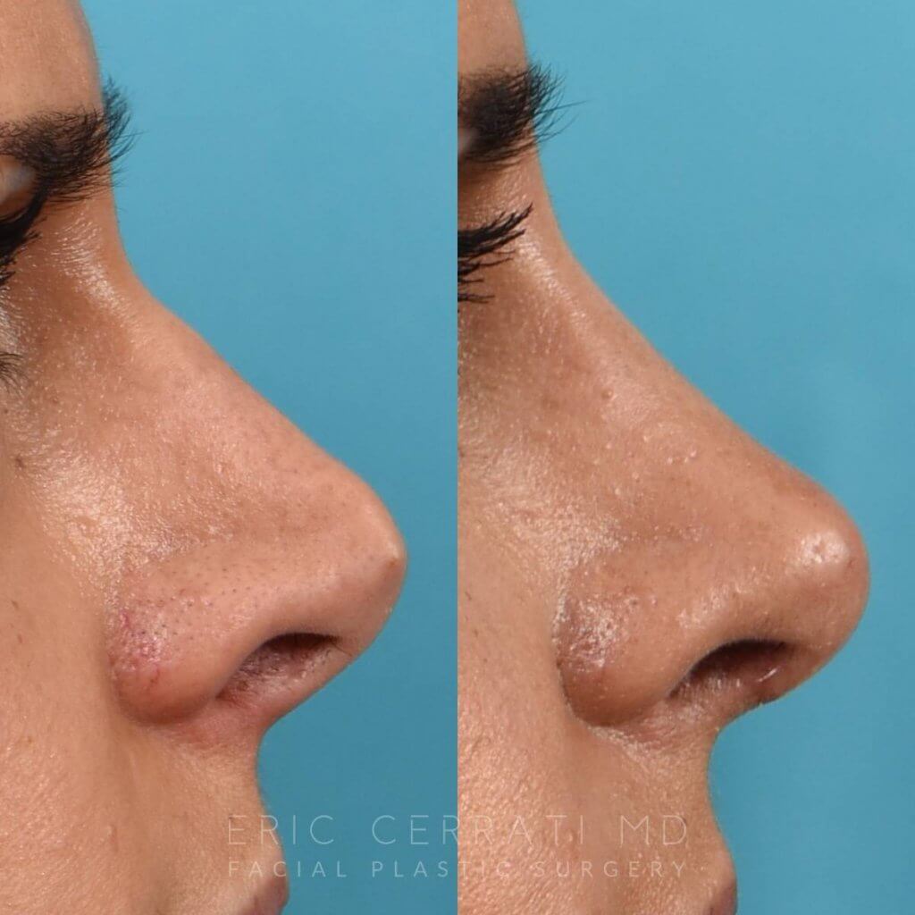 Female Patient Before and After Rhinoplasty