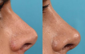 Female Patient Before and After Rhinoplasty
