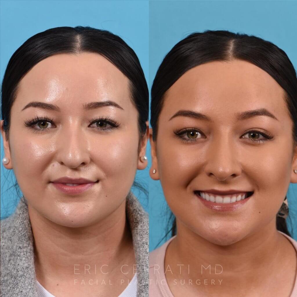Female patient before and after rhinoplasty - front