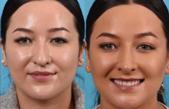 Female patient before and after rhinoplasty - front