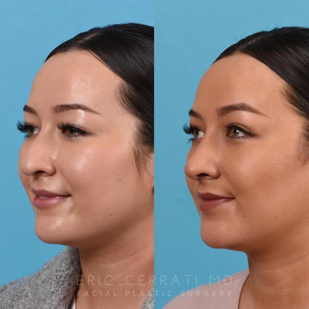 Female patient before and after rhinoplasty - left side.