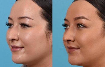 Female patient before and after rhinoplasty - left side.