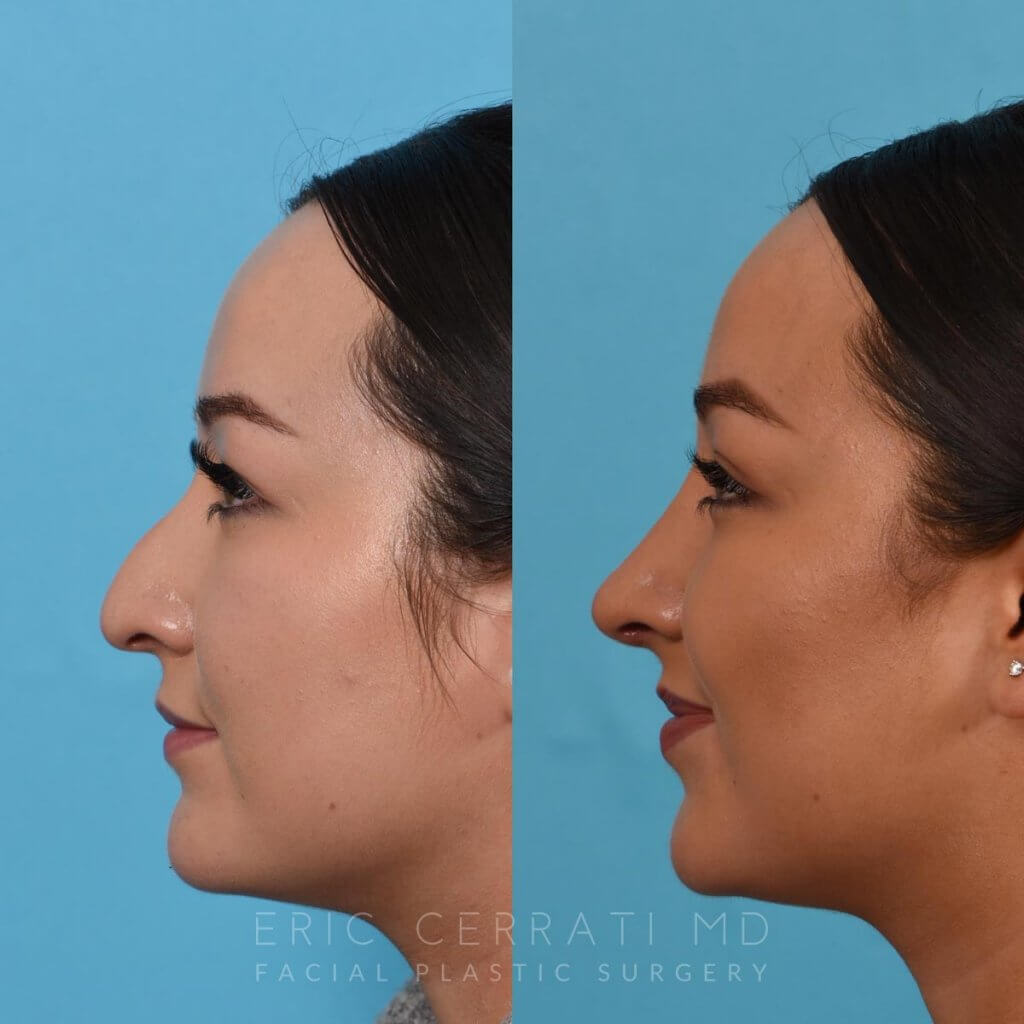 Female patient before and after rhinoplasty - left side.