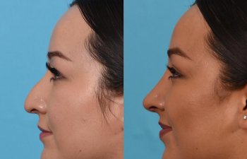Female patient before and after rhinoplasty - left side.