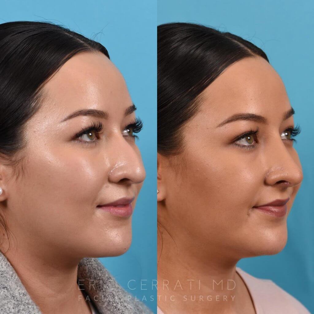Female patient before and after rhinoplasty - right side.