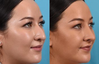 Female patient before and after rhinoplasty - right side.