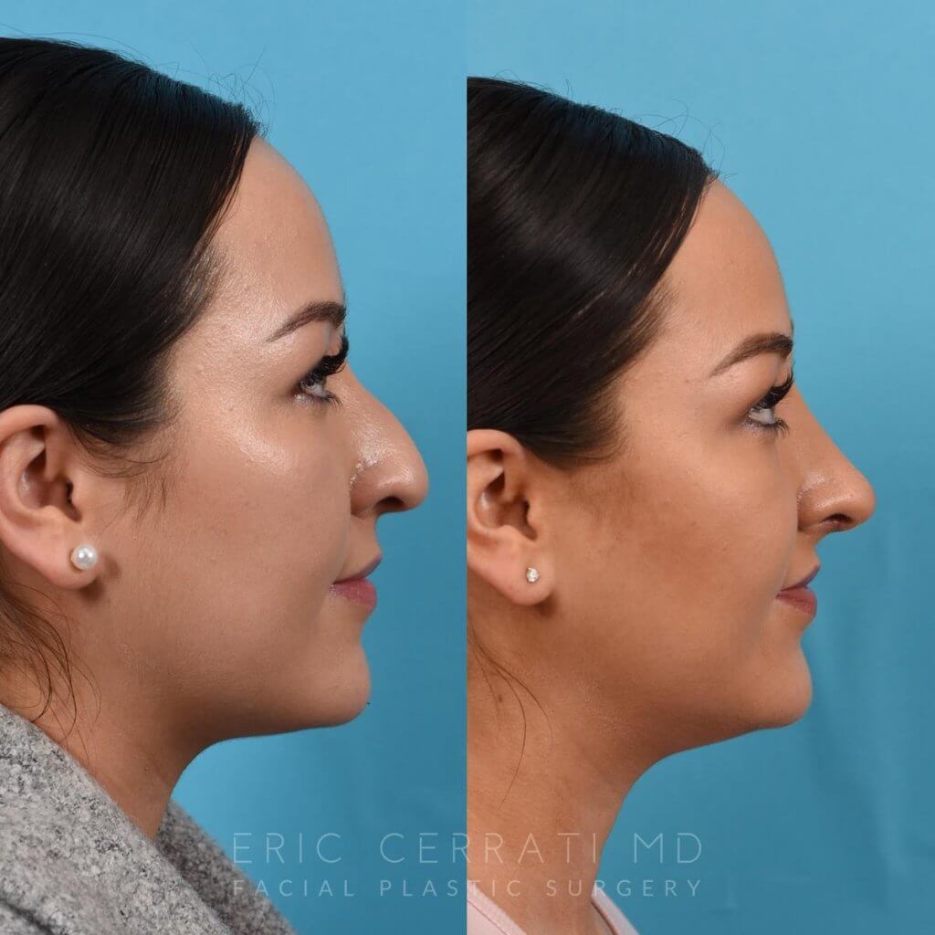 Female patient before and after rhinoplasty - right side.