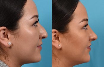 Female patient before and after rhinoplasty - right side.