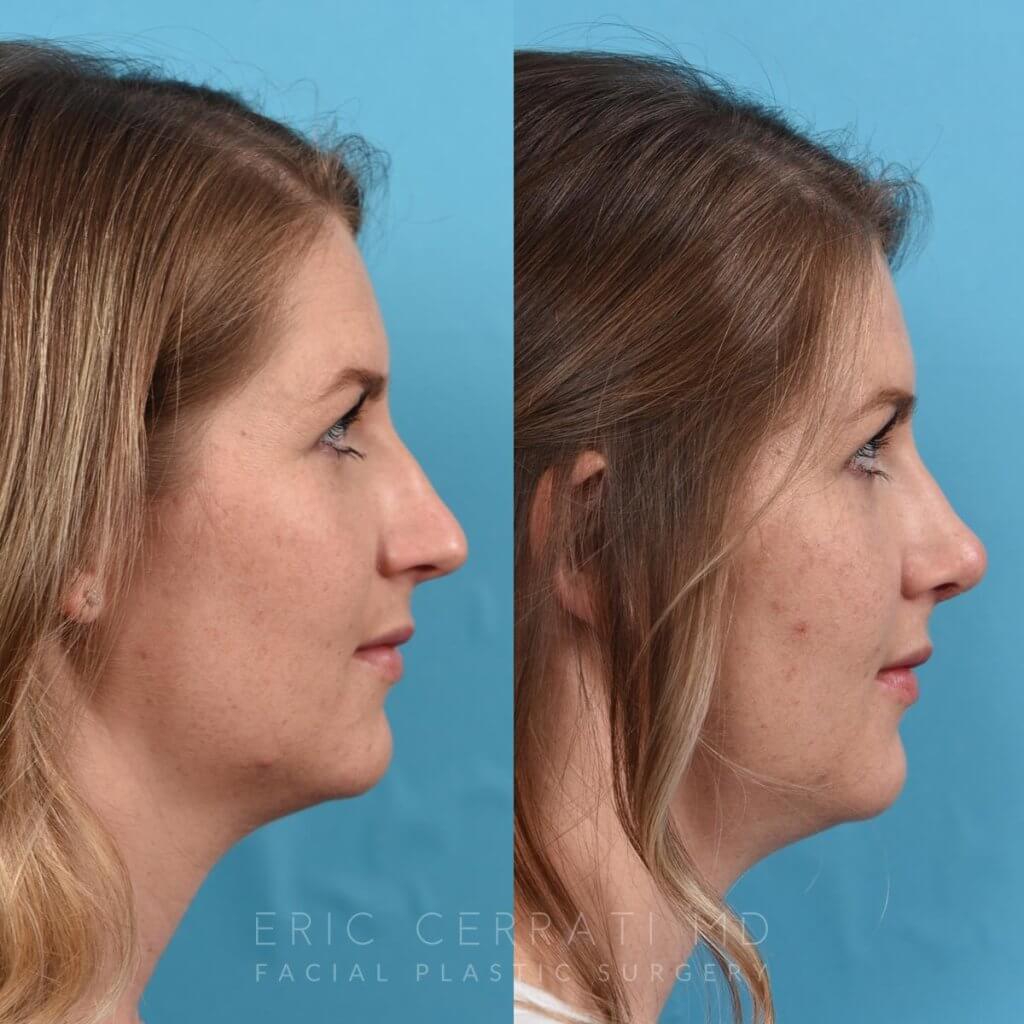 Female patient before and after rhinoplasty - right side.