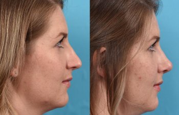 Female patient before and after rhinoplasty - right side.