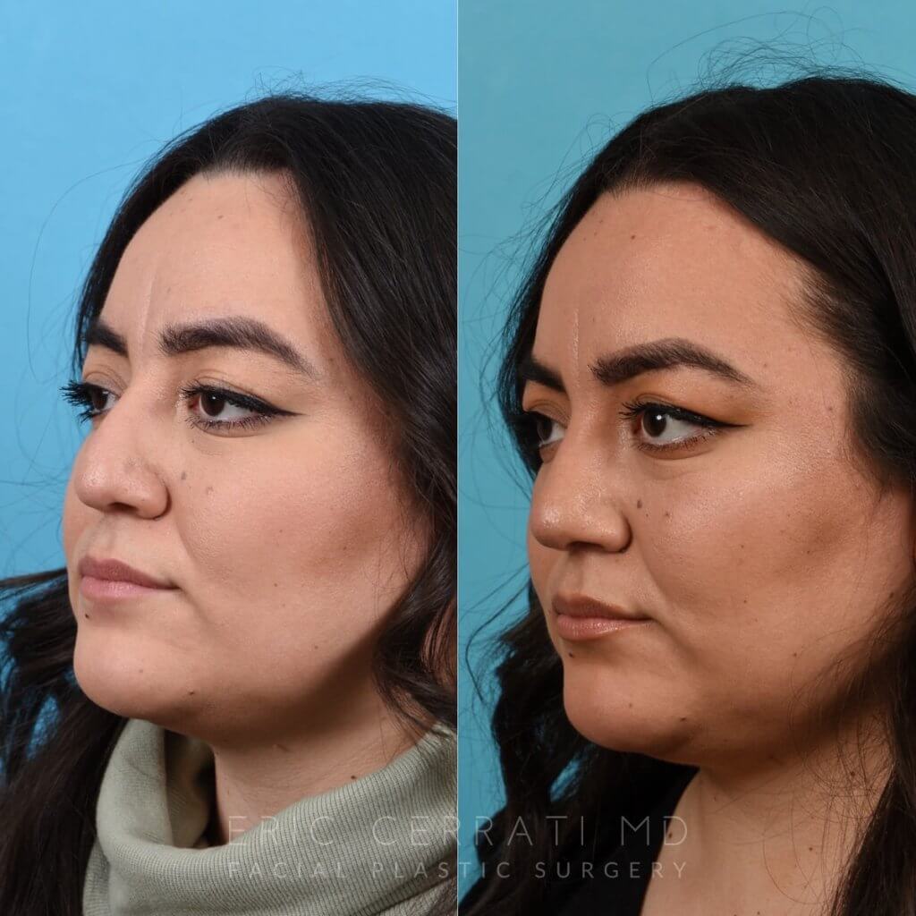 Female patient before and after rhinoplasty - left side
