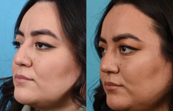 Female patient before and after rhinoplasty - left side
