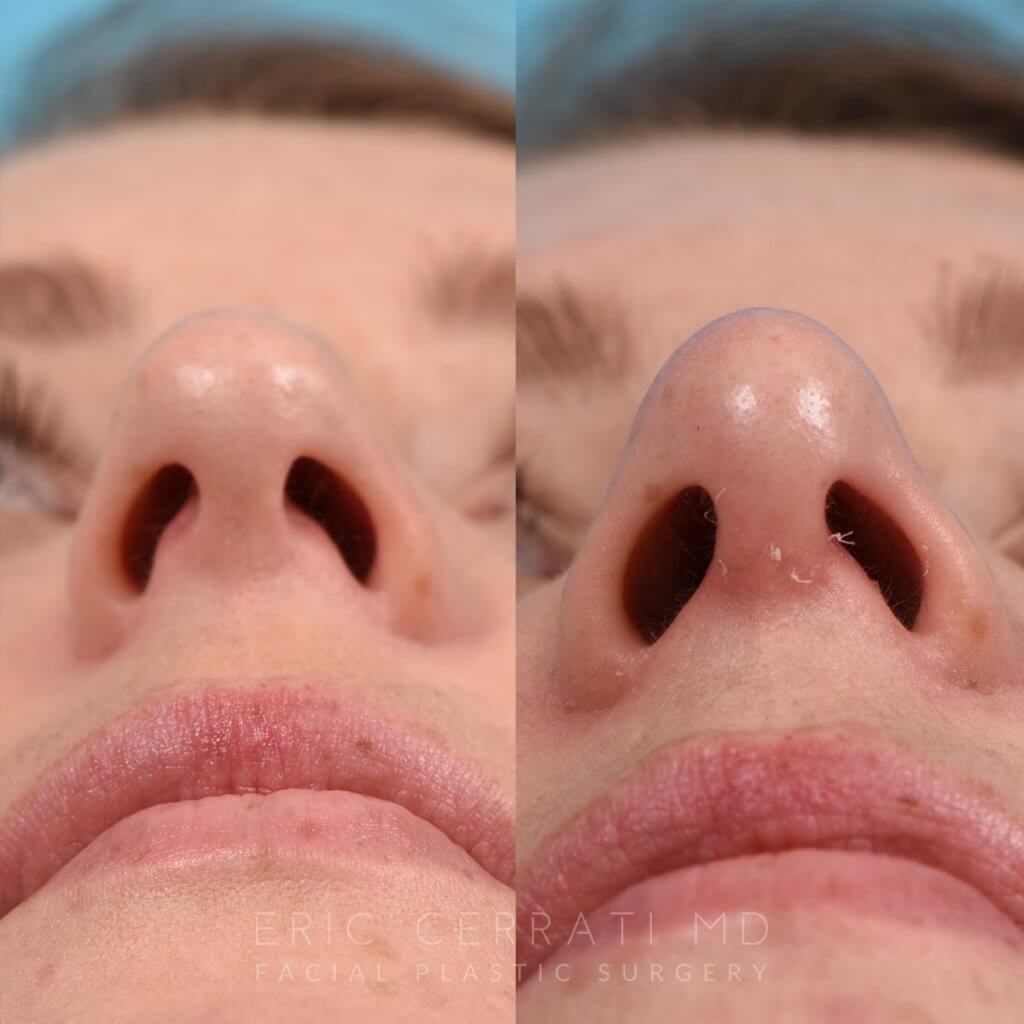 female patient before and after rhinoplasty - front