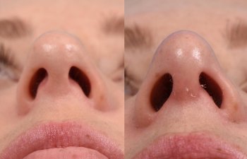 female patient before and after rhinoplasty - front