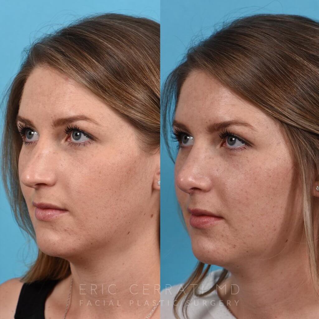 Female patient before and after rhinoplasty - left side.