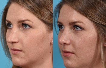 Female patient before and after rhinoplasty - left side.