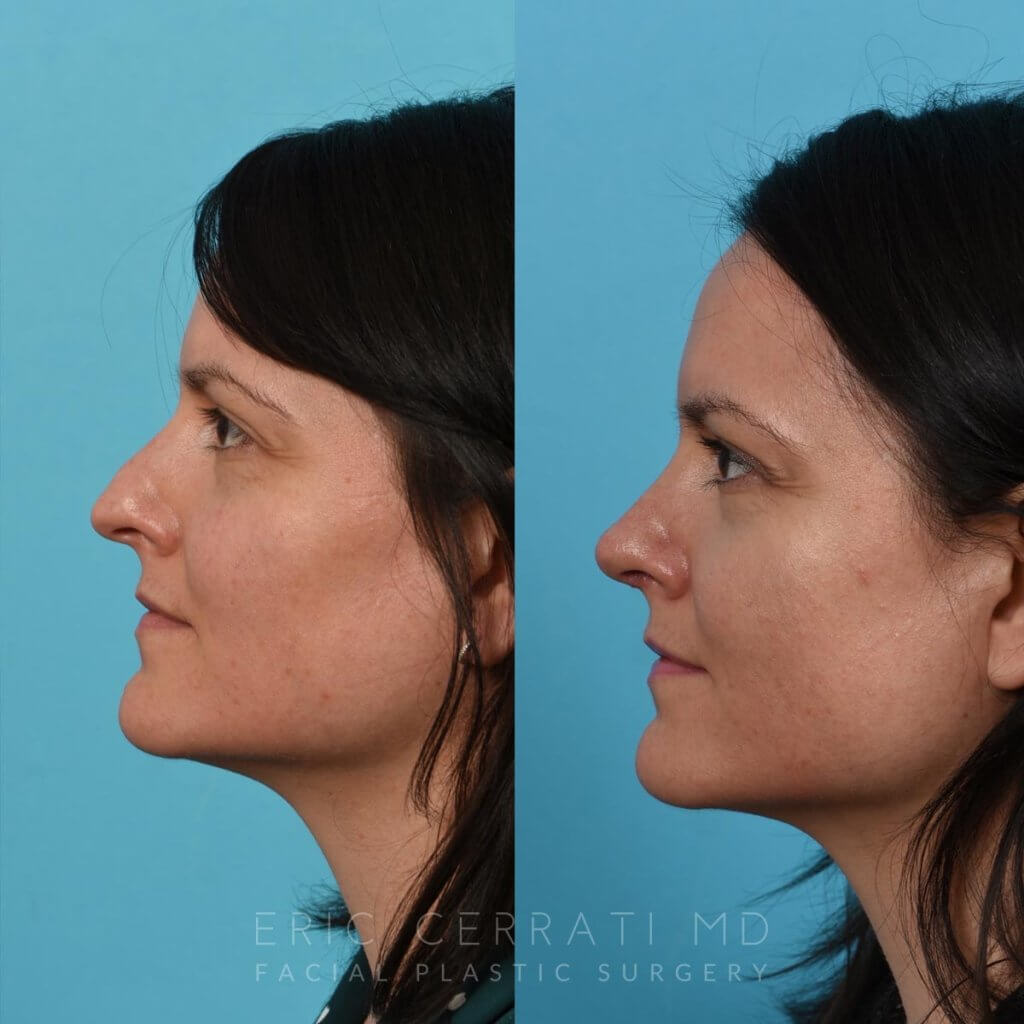 Female patient before and after rhinoplasty - left side.