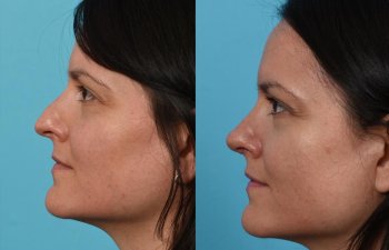 Female patient before and after rhinoplasty - left side.