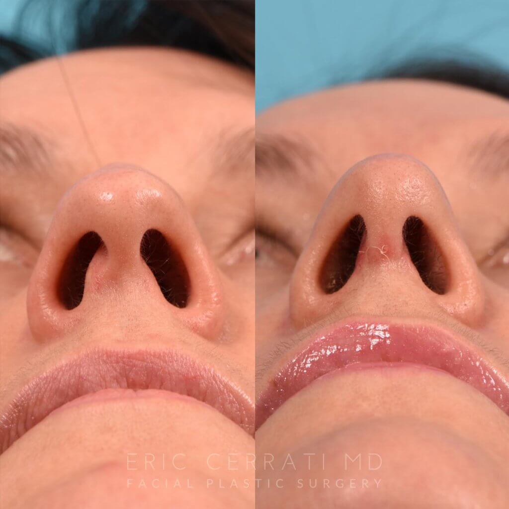 female patient before and after rhinoplasty - front