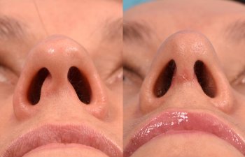 female patient before and after rhinoplasty - front
