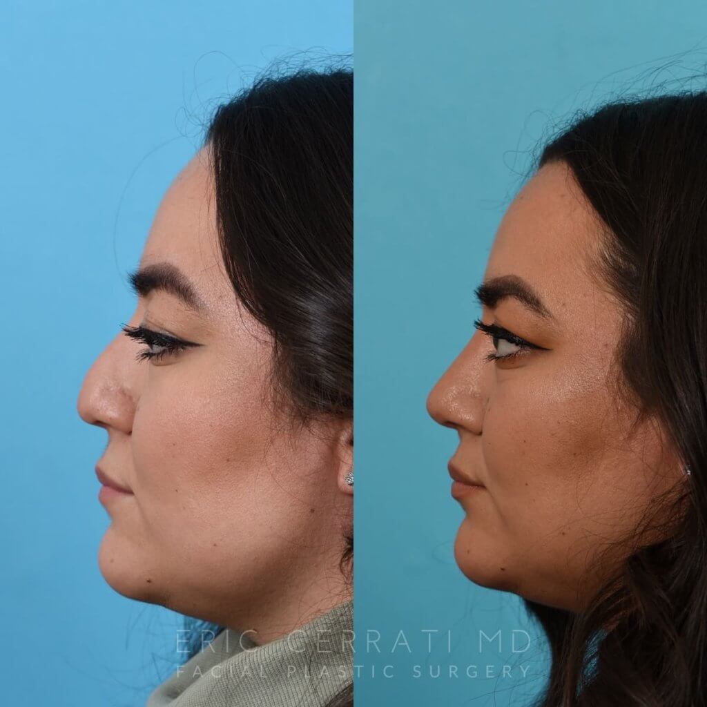Female patient before and after rhinoplasty - left side