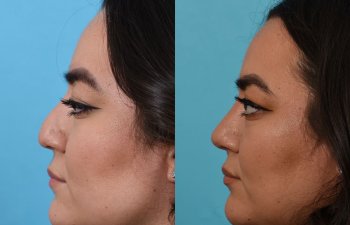 Female patient before and after rhinoplasty - left side