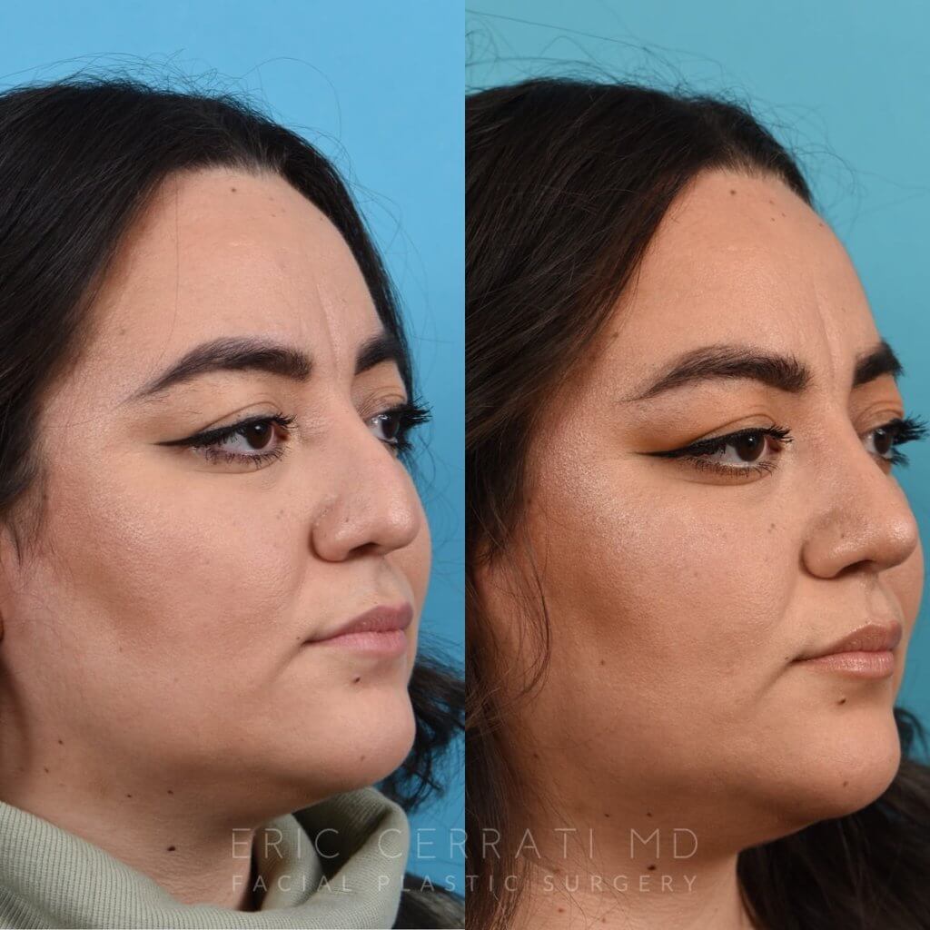 Female patient before and after rhinoplasty - right side