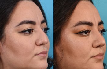 Female patient before and after rhinoplasty - right side