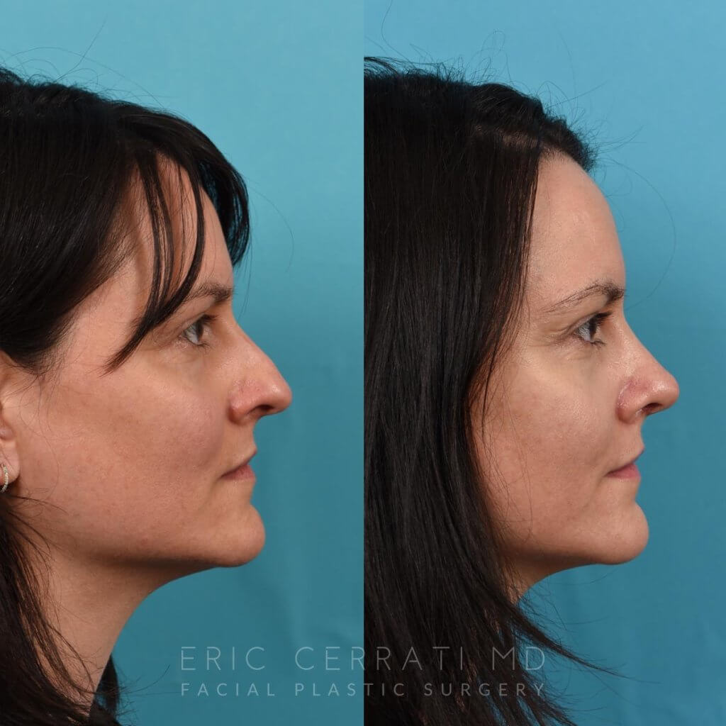 Female patient before and after rhinoplasty - right side.