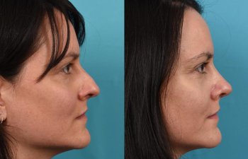Female patient before and after rhinoplasty - right side.