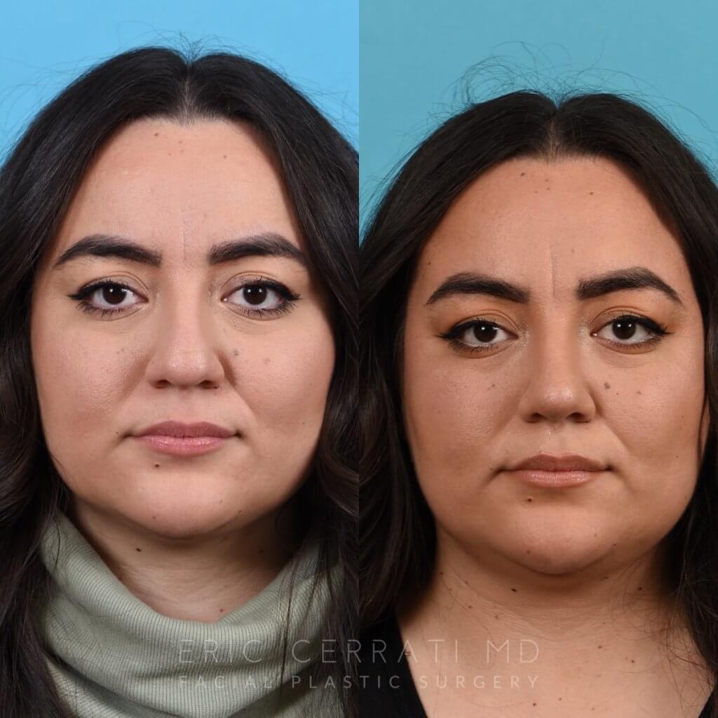 Female patient before and after rhinoplasty -front
