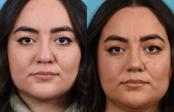 Female patient before and after rhinoplasty -front