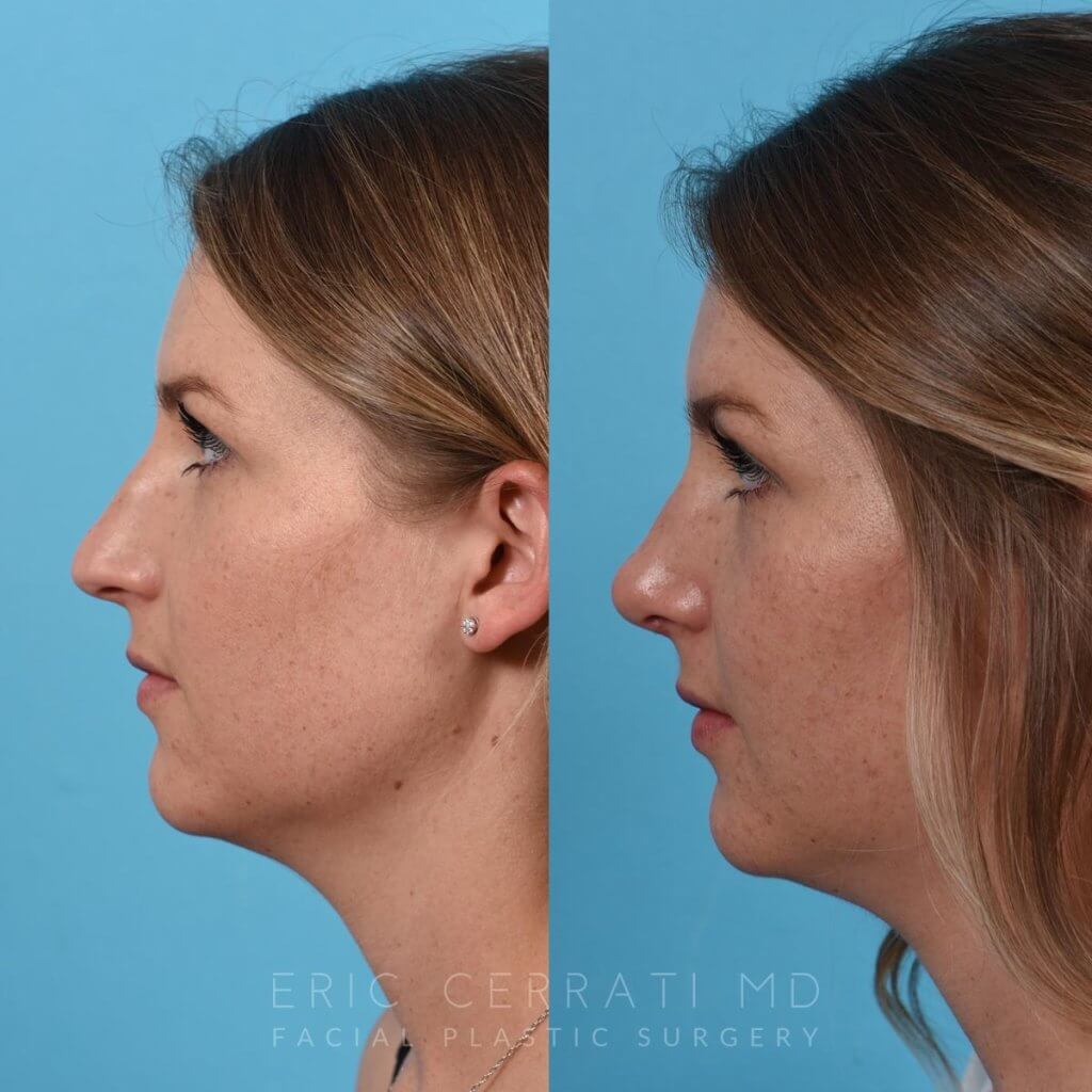 Female patient before and after rhinoplasty - left side.
