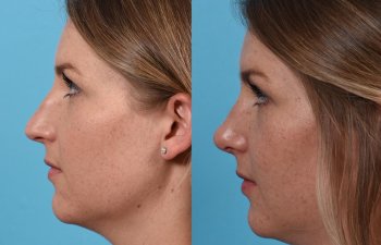 Female patient before and after rhinoplasty - left side.