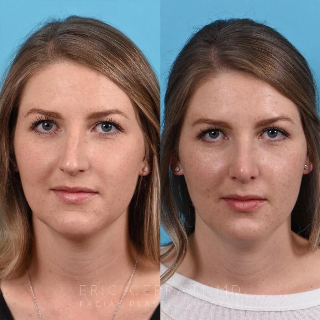 Female patient before and after rhinoplasty - front