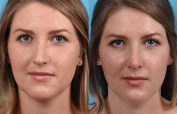 Female patient before and after rhinoplasty - front