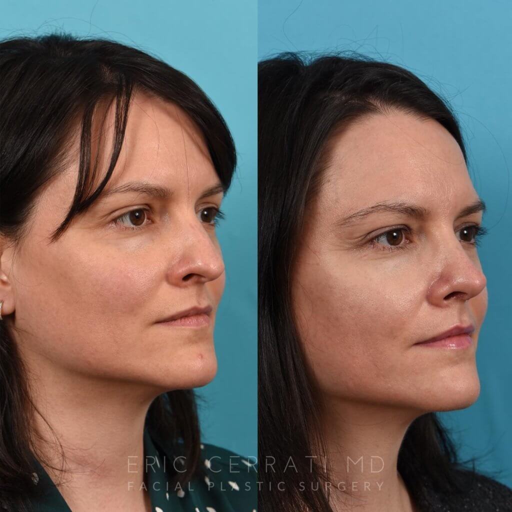 Female patient before and after rhinoplasty - right side.