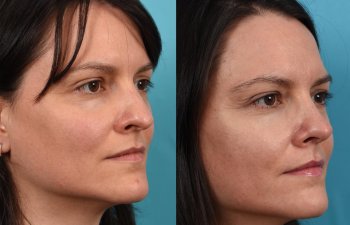 Female patient before and after rhinoplasty - right side.