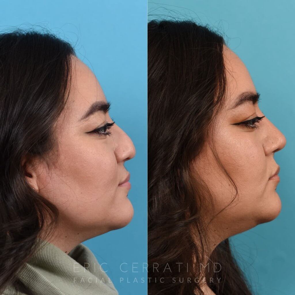 Female patient before and after rhinoplasty - right side