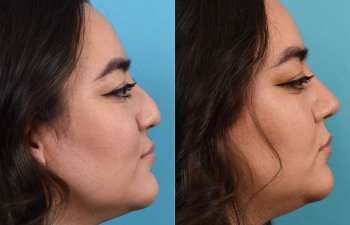 Female patient before and after rhinoplasty - right side
