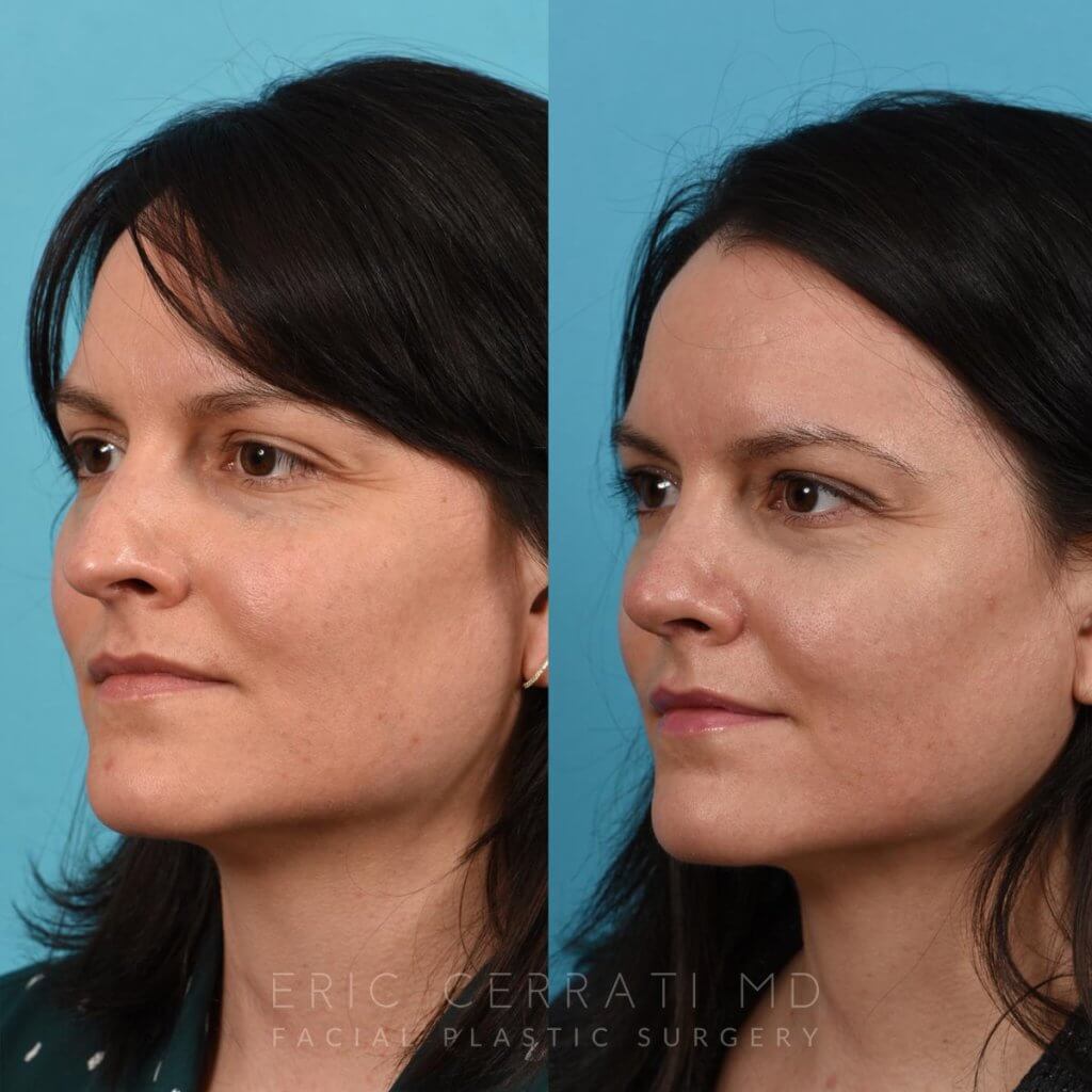 Female patient before and after rhinoplasty - left side.