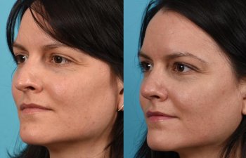 Female patient before and after rhinoplasty - left side.