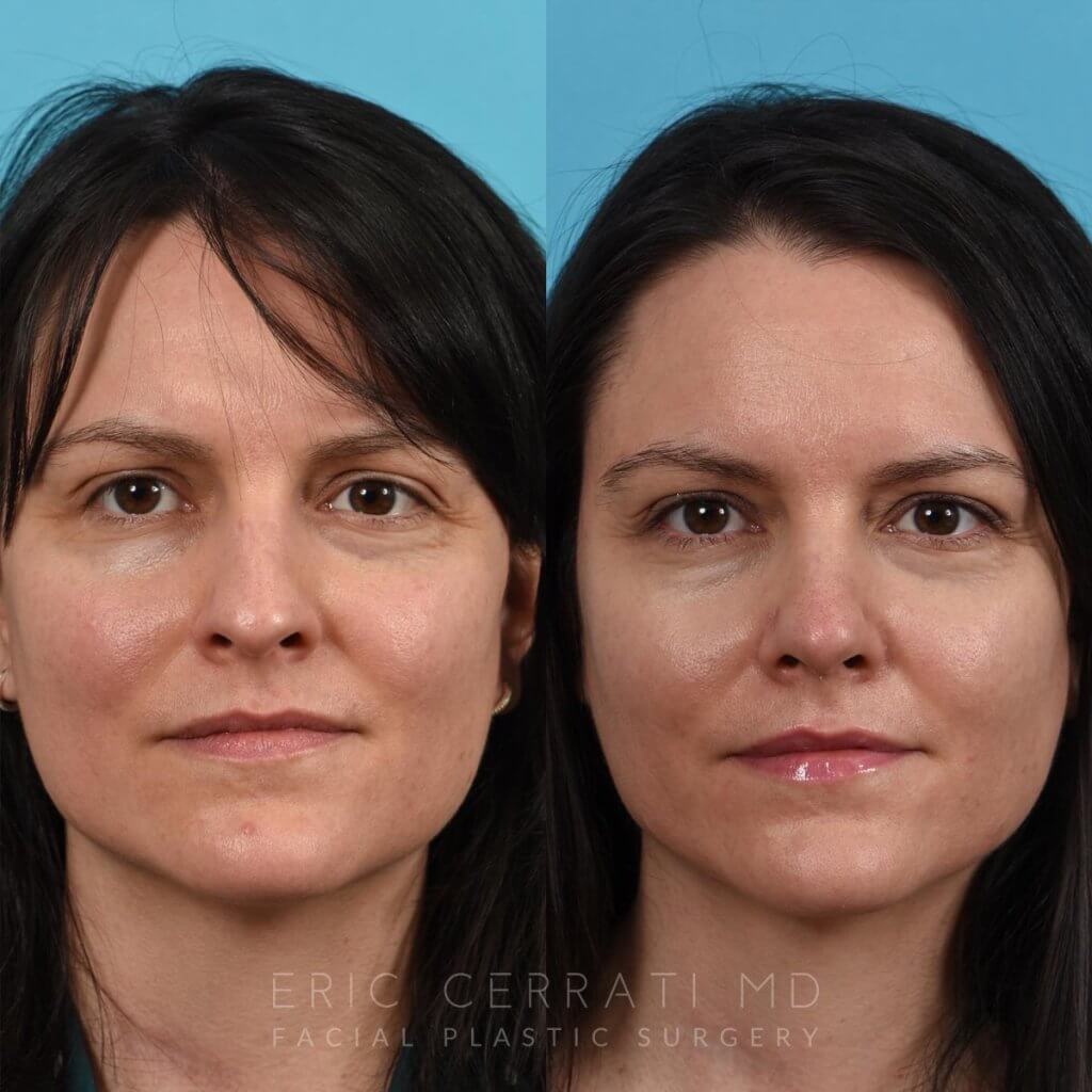 Female patient before and after rhinoplasty - front