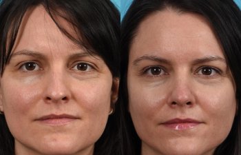 Female patient before and after rhinoplasty - front