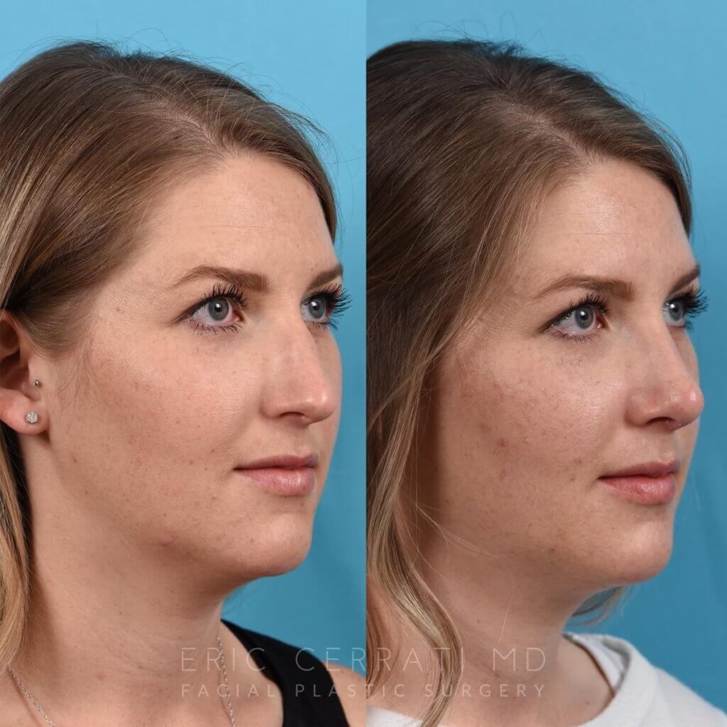 Female patient before and after rhinoplasty - right side.